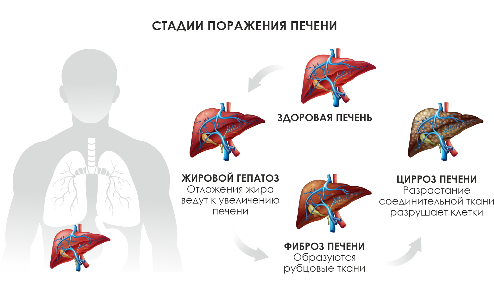 Стадии поражения печени